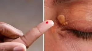 3 Masalah Mata yang Disebabkan oleh Kolesterol Tinggi 